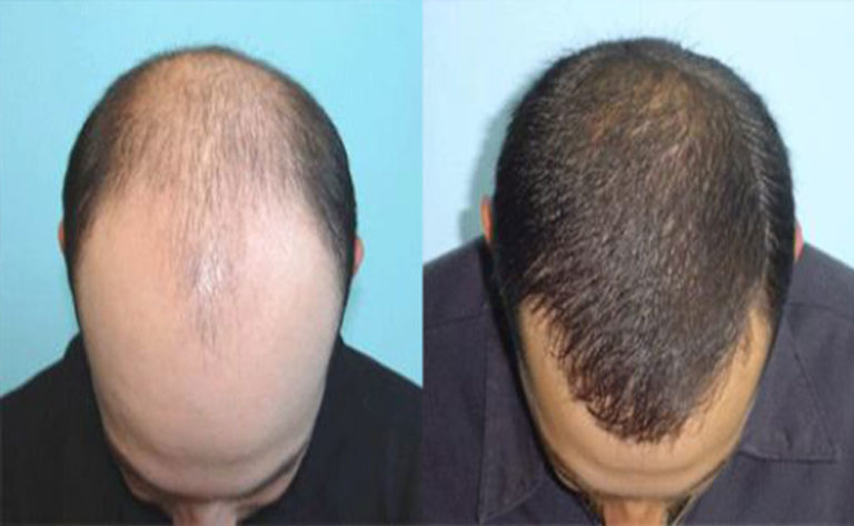 tratamento natural contra calvície